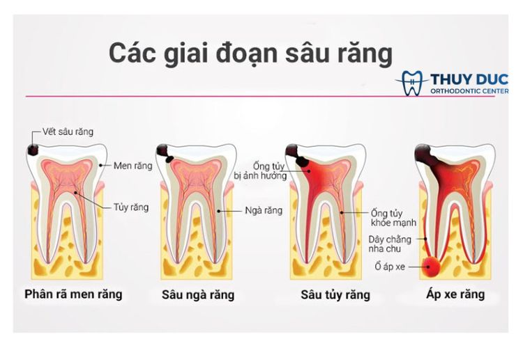 Các giai đoạn phát triển của răng sâu 1