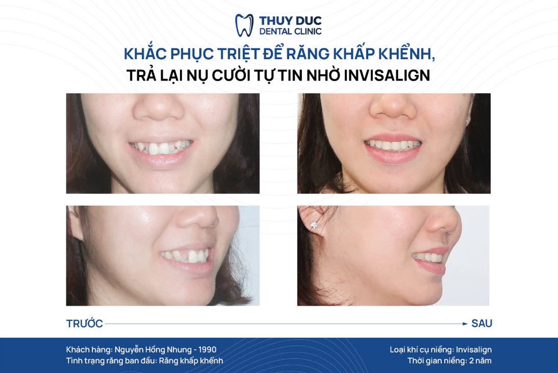 Hình ảnh một số ca niềng răng 9630 tại nha khoa Thúy Đức 4