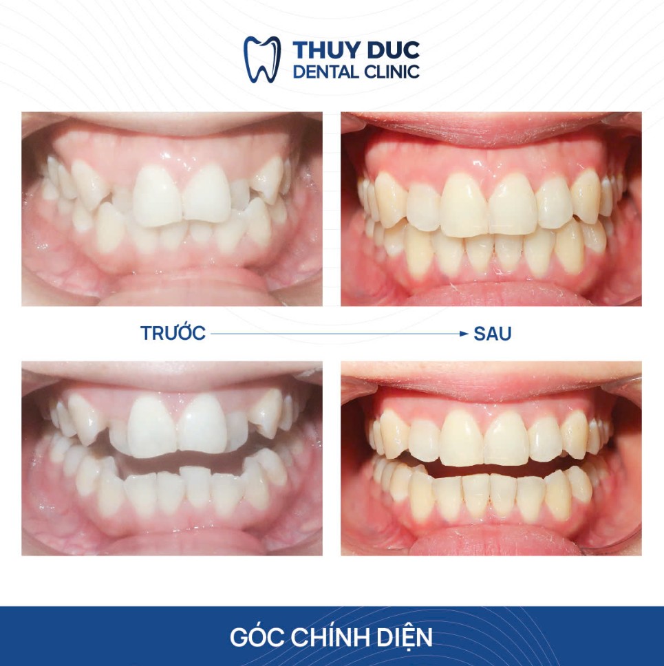 Hình ảnh một số ca niềng răng 9630 tại nha khoa Thúy Đức 5