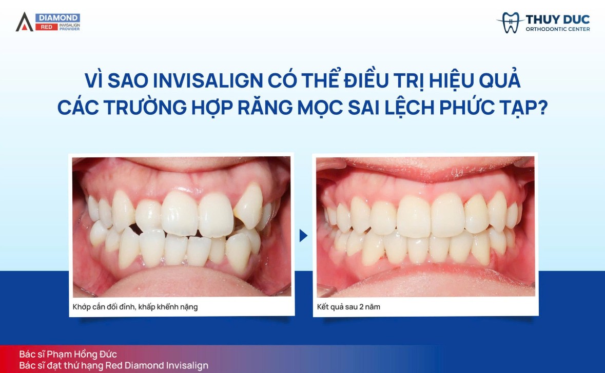 Hình ảnh một số ca niềng răng 9630 tại nha khoa Thúy Đức 3