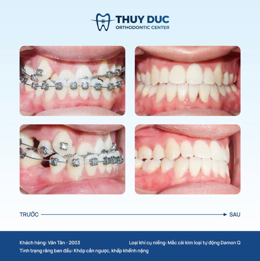 Hình ảnh một số ca niềng răng 9630 tại nha khoa Thúy Đức 1
