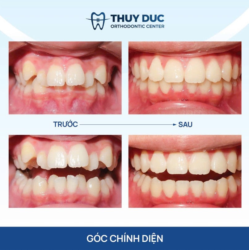 2. Khác biệt giữa chỉnh nha thông thường và chỉnh nha tiền phục hình 1