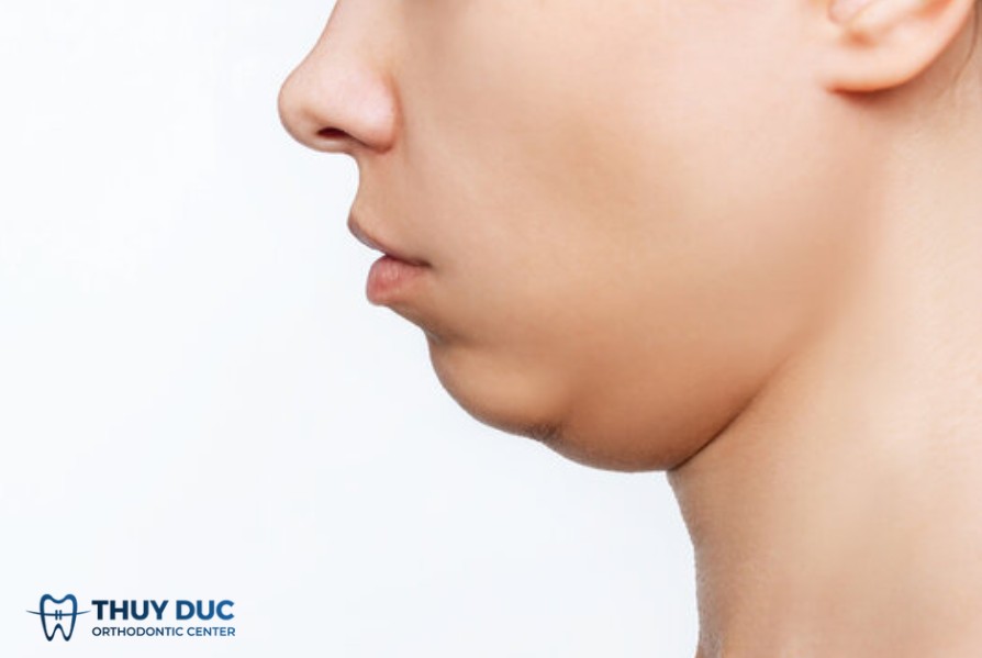 Nguyên nhân gây cằm lẹm 1 Nguyên nhân gây cằm lẹm 1