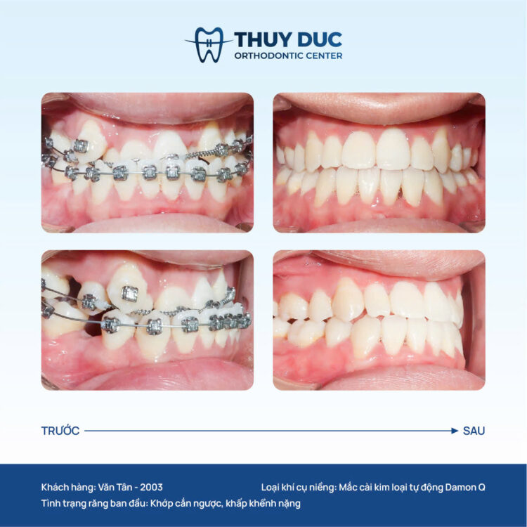 Kết quả điều trị tối ưu 1 Kết quả điều trị tối ưu 1