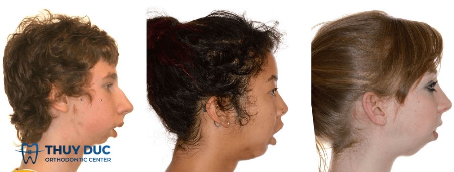 Thế nào là cằm lẹm? 1 Thế nào là cằm lẹm? 1