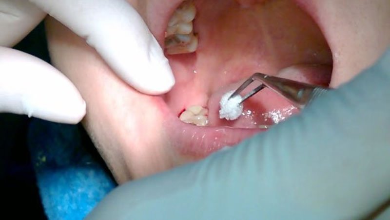Tại sao cần chăm sóc sau khi nhổ răng khôn? 1