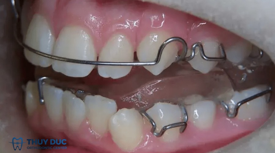 Dùng khí cụ chức năng cho trẻ đang trong độ tuổi phát triển 1 Dùng khí cụ chức năng cho trẻ đang trong độ tuổi phát triển 1