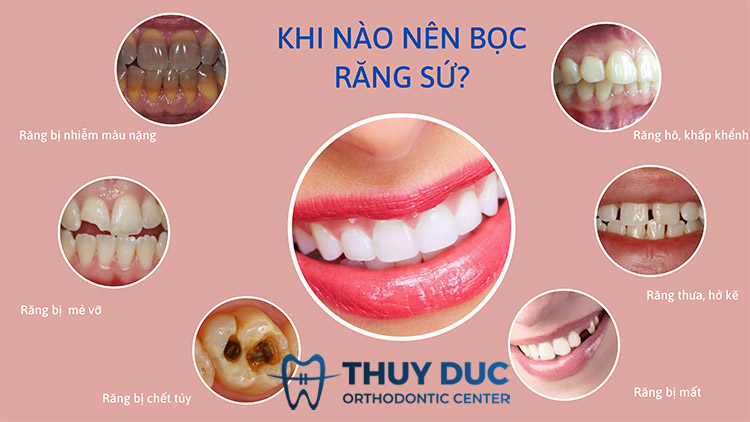 Khi nào nên bọc sứ? 1