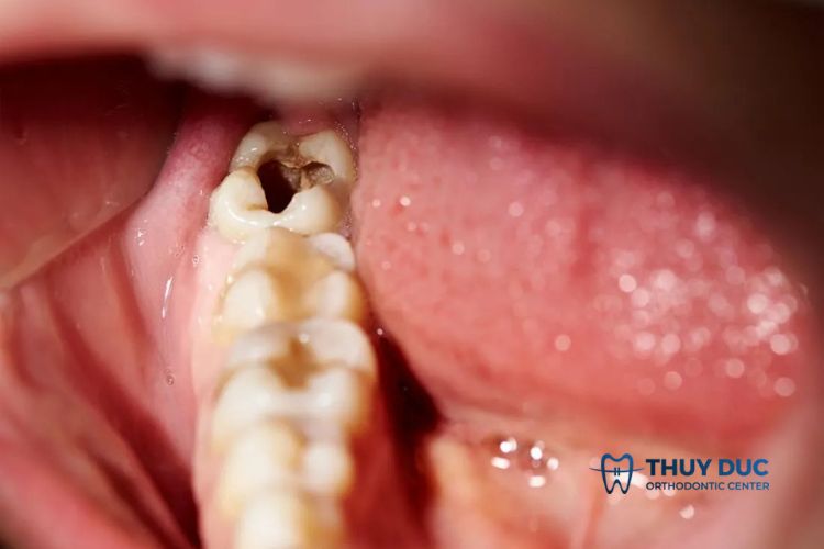 Răng khôn gây sốt, viêm và sưng nướu 1