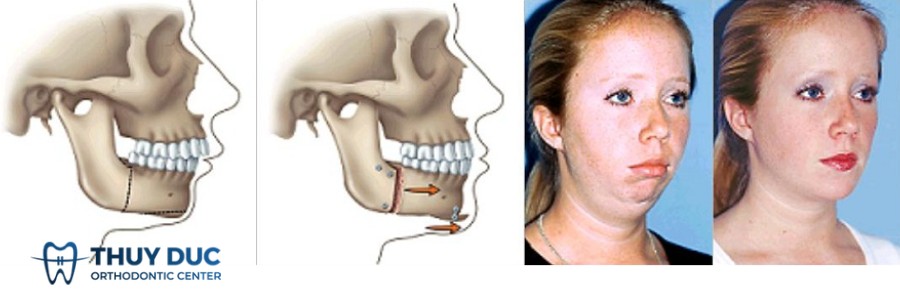 Phẫu thuật hàm 1 Phẫu thuật hàm 1