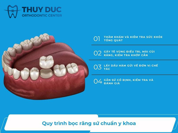 Quy trình bọc sứ đúng chuẩn như thế nào? 1