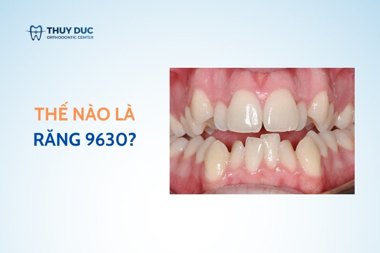 Răng 9630 là gì? Có cách nào khắc phục không? 1