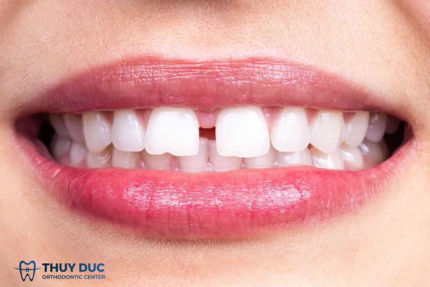 Quan điểm của nha khoa Thúy Đức về răng cửa thưa 1