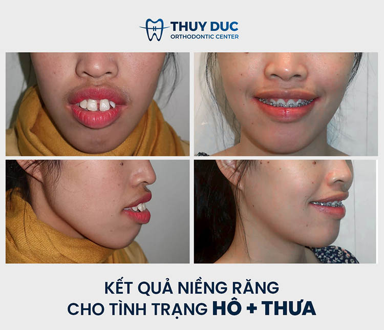 Trọn bộ hình ảnh thay đổi bất ngờ trước - sau niềng răng ...