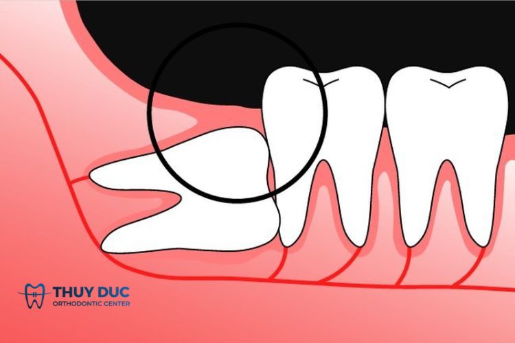 Xem chi tiết: Nhổ răng khôn nên nhổ mấy cái? 1