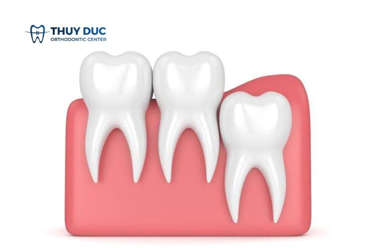 Trường hợp nào răng khôn mọc thẳng không phải nhổ? 1