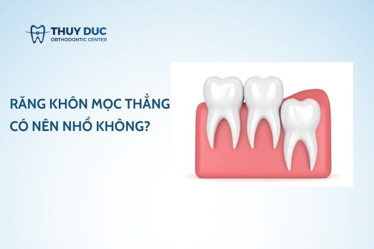 Răng khôn mọc thẳng có nên nhổ không?