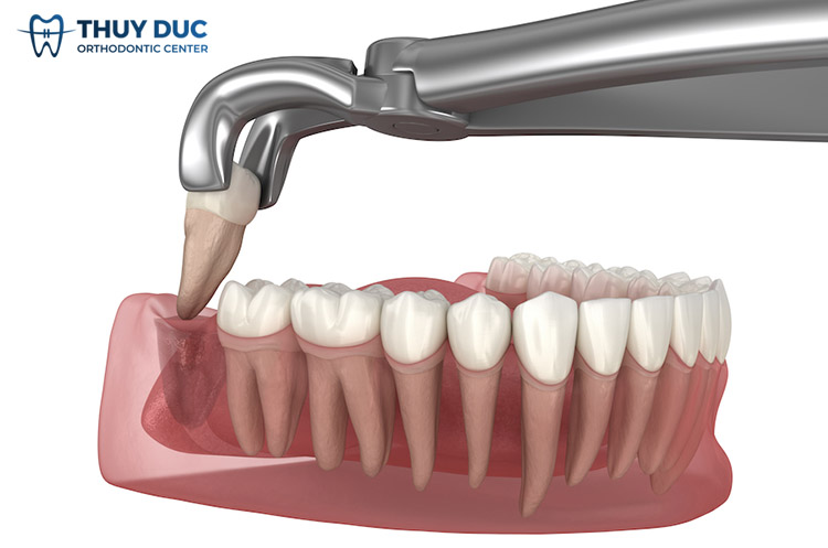 Tại sao cần phải nhổ răng khôn? 1 Tại sao cần phải nhổ răng khôn? 1
