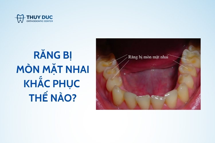 Cẩn trọng khi răng bị mòn mặt nhai! 1