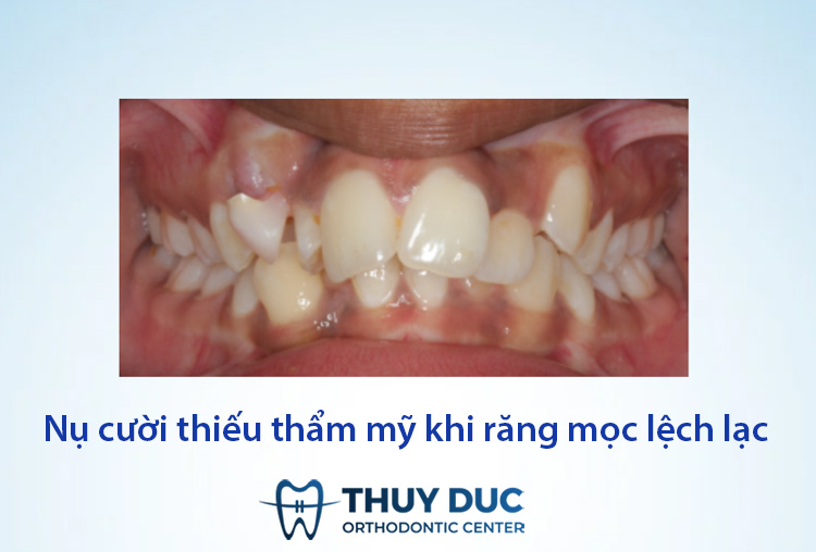 Khớp cắn sai lệch, mất cân đối 1