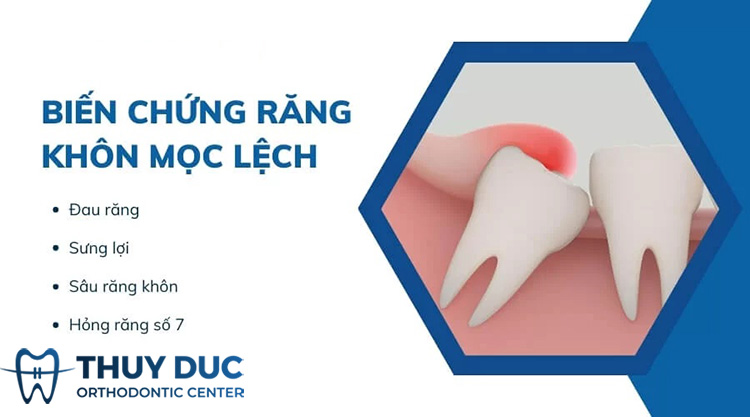 Răng khôn mọc lệch có ảnh hưởng gì không? 1