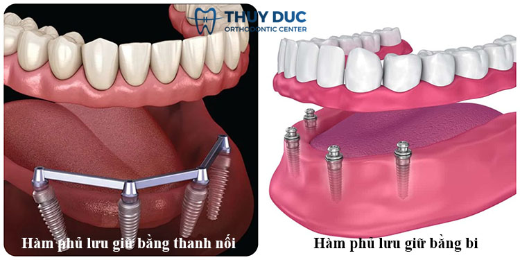 2. Các loại hàm phủ trên Implant phổ biến hiện nay 1