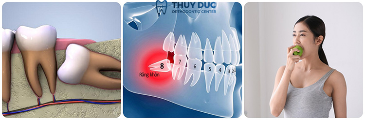 3. Các yếu tố cần xem xét trước khi nhổ răng khôn 1