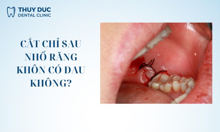 Sau khi nhổ răng khôn, quên cắt chỉ có sao không? 1