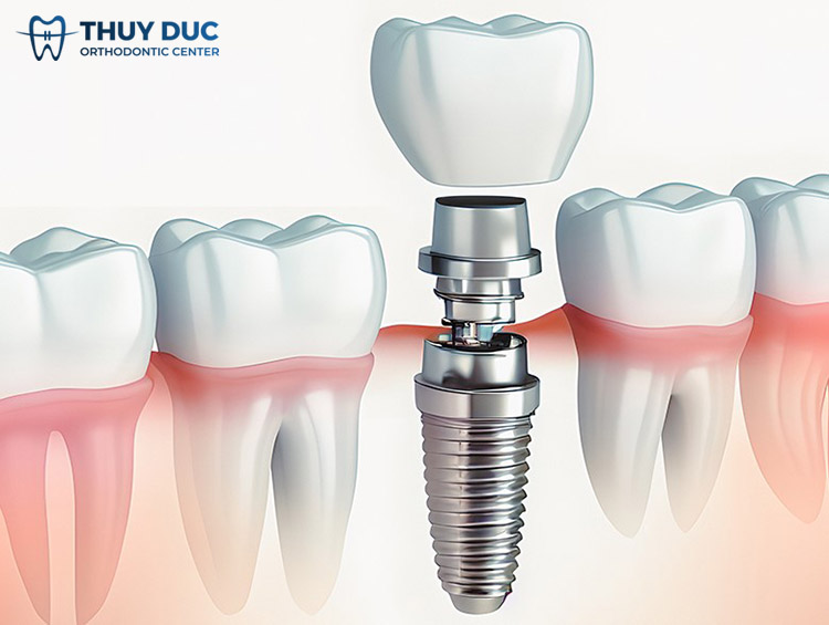 1. Cấu tạo chi tiết của răng implant 1