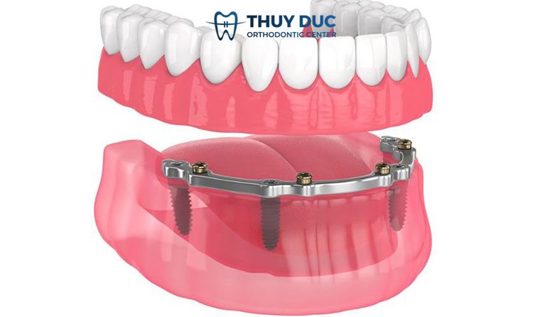 1. Cấu tạo của thanh bar implant gồm những gì? 1