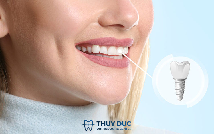 2. Độ bền của răng implant kéo dài bao lâu? 1