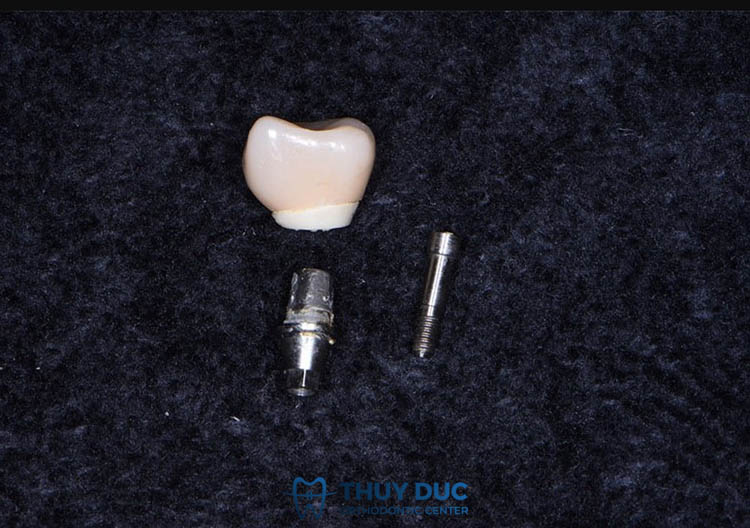 4. Trụ implant bị gãy có nguy hiểm không? 1