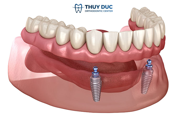 1. Hàm phủ trên Implant là gì? 1