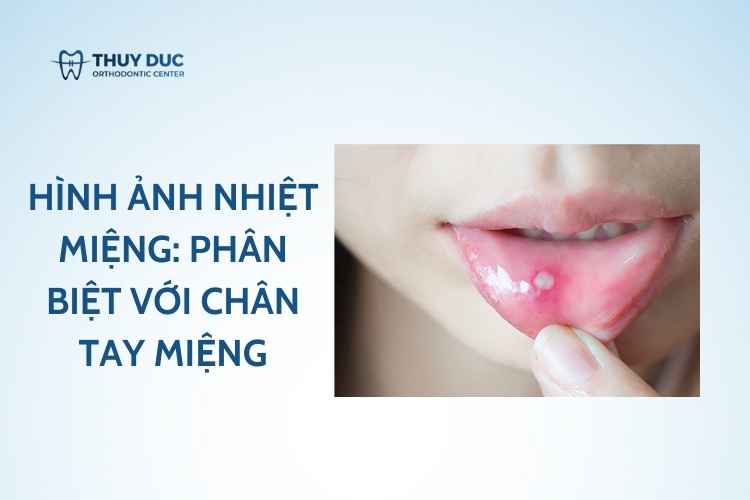 Hình ảnh nhiệt miệng: Phân biệt với các vết loét khác 1