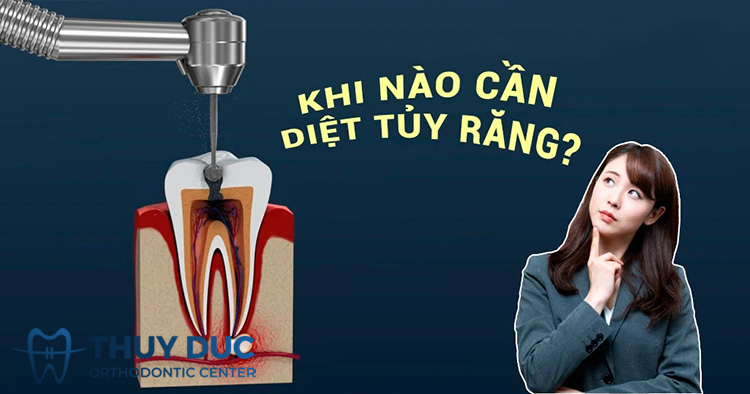 Khi nào nên sử dụng thuốc diệt tủy răng? 1