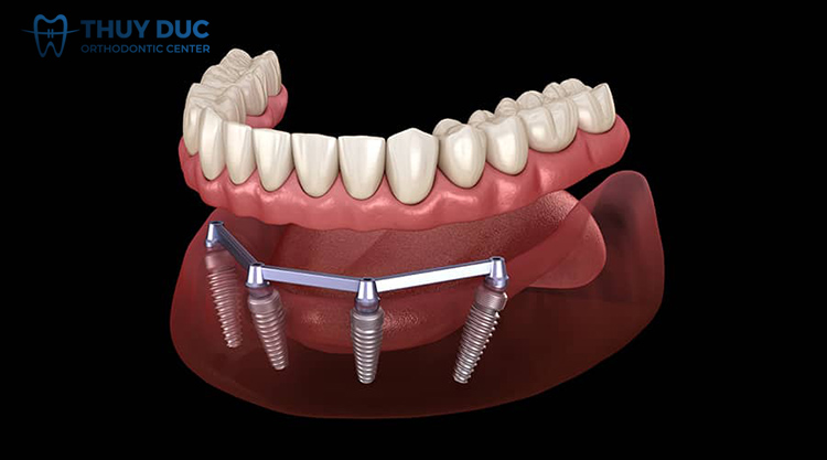 3. Khi nào cần sử dụng thanh bar trên implant? 1