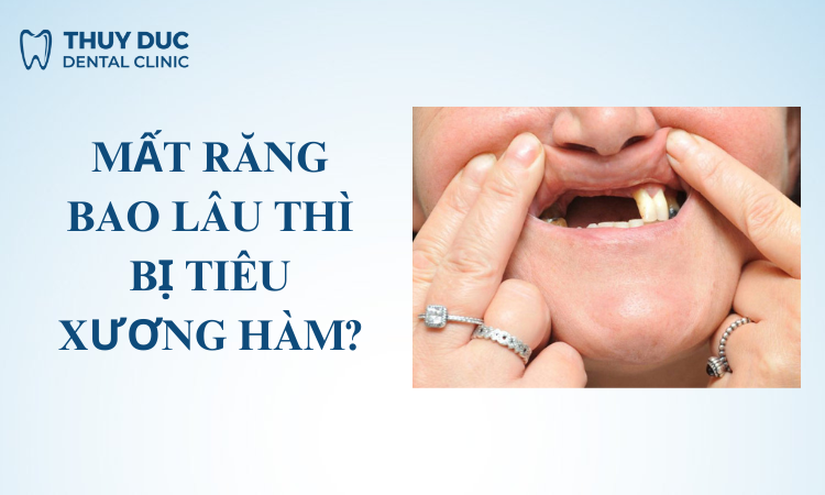 Mất răng sau bao lâu thì bị tiêu xương? 1