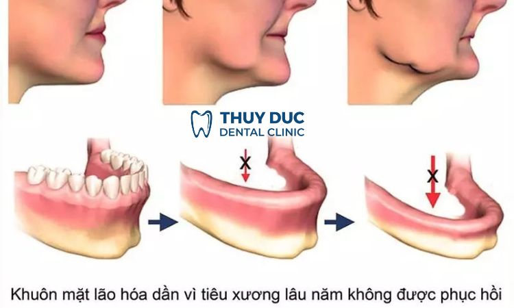 Cản trở phục hình răng 1