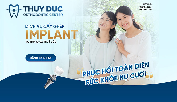 Địa chỉ cấy ghép răng Implant an toàn, uy tín 1