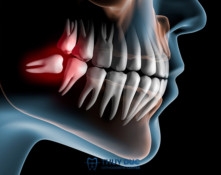 4. Nhổ răng khôn có ảnh hưởng thần kinh không? 1