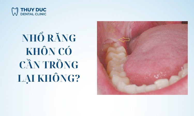 Nhổ răng khôn có cần trồng lại không? 1