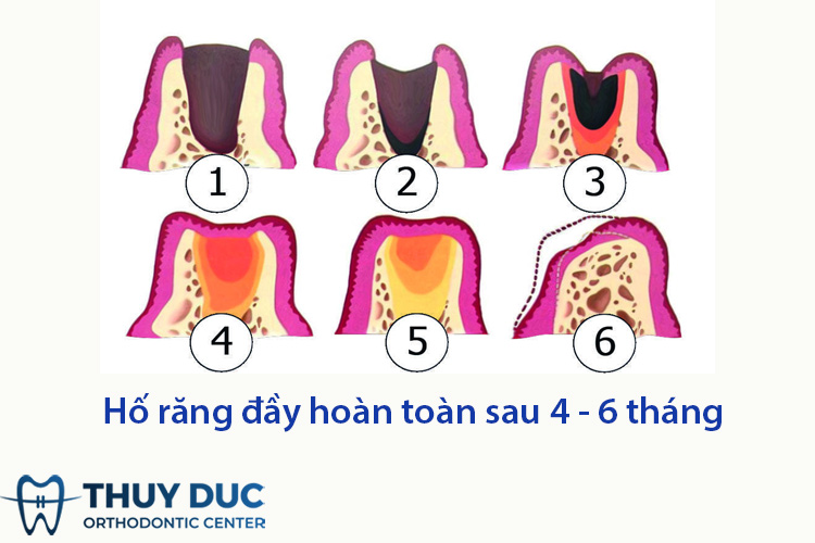 Tìm hiểu thêm về tốc độ lành thương sau khi nhổ răng 1