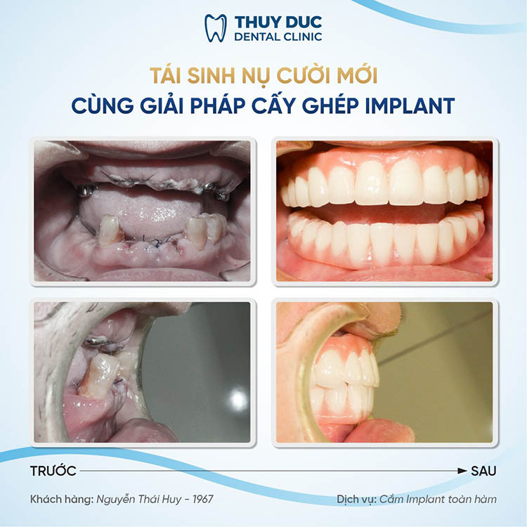 6. Địa chỉ trồng Implant chất lượng tại Hà Nội 2