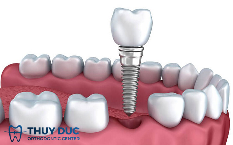 Implant ETK Pháp phù hợp trồng răng nào? 1