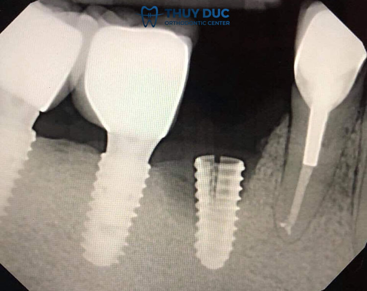 Trụ implant bị vỡ, lung lay 1