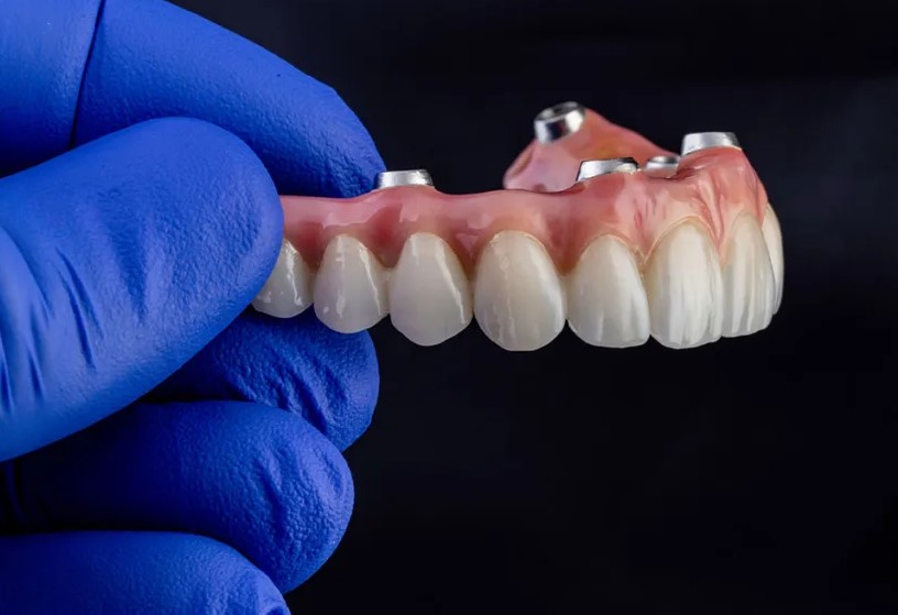 4. Trường hợp nào nên sử dụng hàm phủ trên Implant? 1