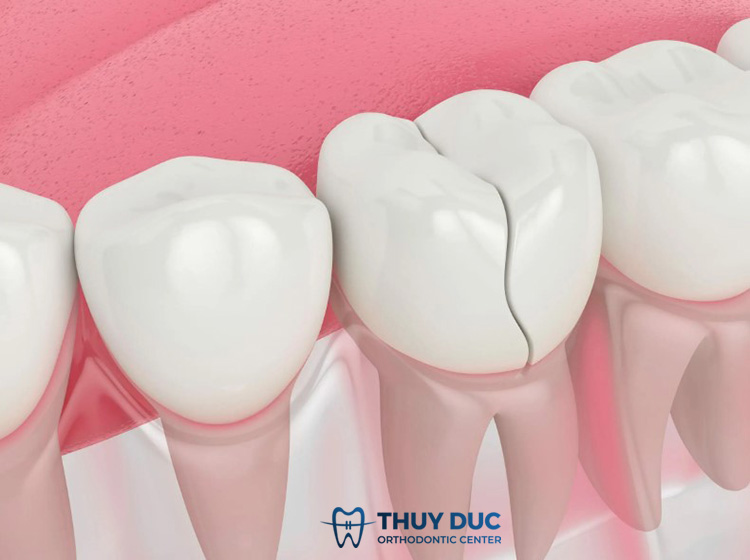 Răng sứ trên implant bị vỡ 1