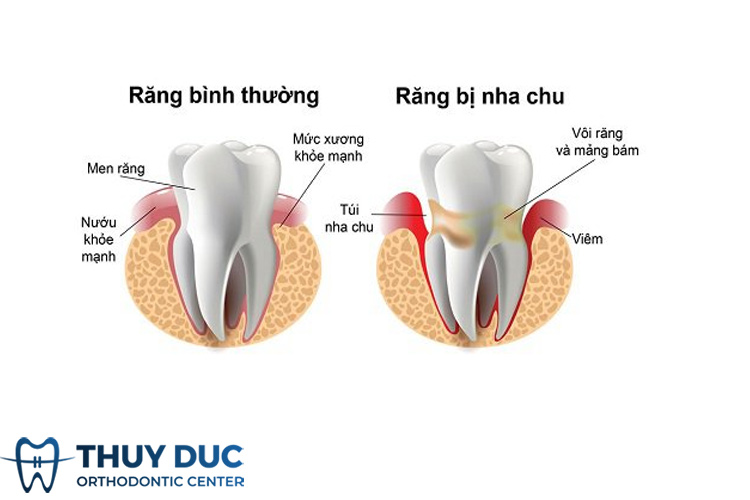 Các vấn đề răng miệng có thể gây nổi hạch ở cổ 1