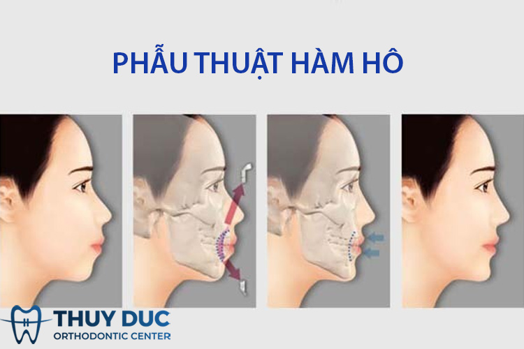 Phẫu thuật hàm hô có nguy hiểm không? 1