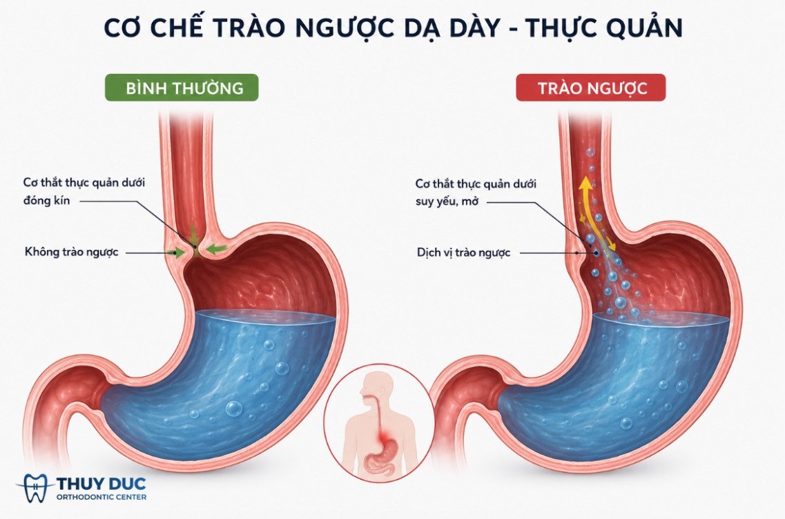 4. Trào ngược dạ dày - thực quản (GERD) 1 4. Trào ngược dạ dày - thực quản (GERD) 1